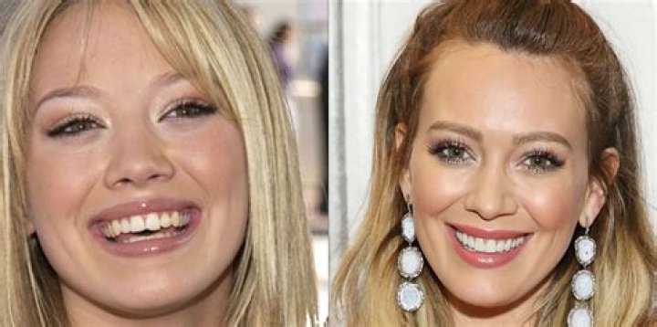 18 Celebrities With Veneers