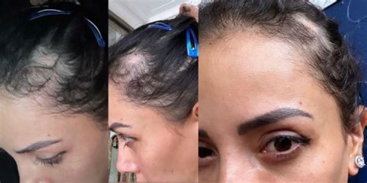90 Day Fiancé- Jasmine Pineda’s Alopecia Hair Condition Explained