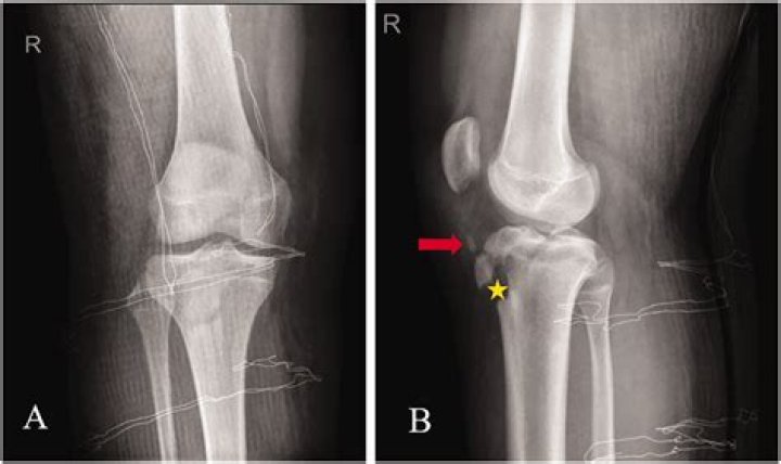 A popliteal false aneurysm caused by an avulsion fracture of the femur: A case presenting with deep venous thrombosis - ePrints
