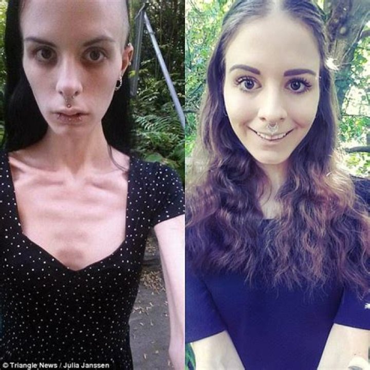 Anorexic girl who hid food in her EARS was warned she could die as she hit 5st 9lbs... but now she's on the road to recovery