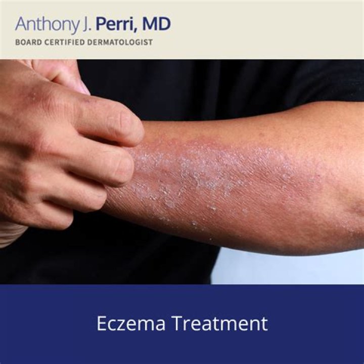 Breast Eczema: Doctors Share How To Ease the Itch and Irritation