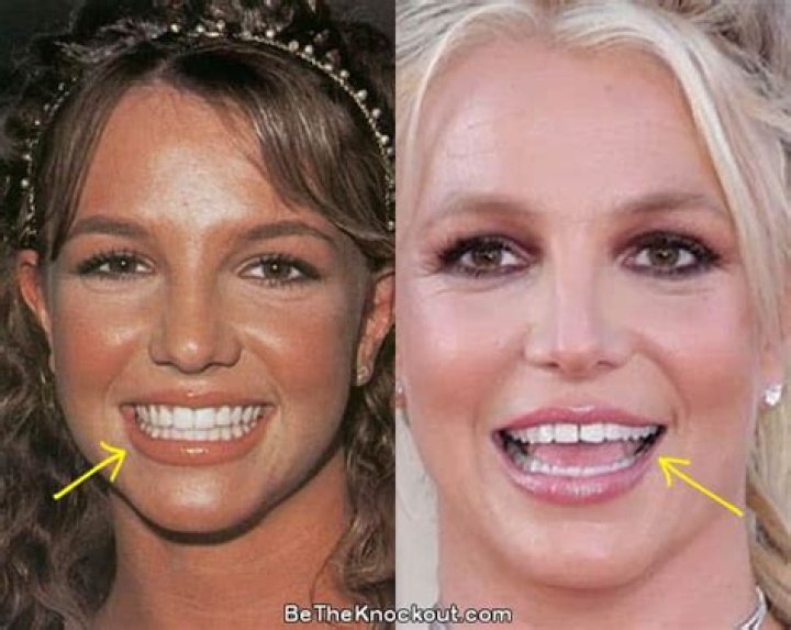 Britney Spears Teeth Before and After