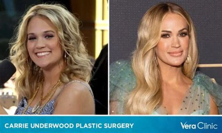 Carrie Underwood’s Plastic Surgery: Here’s What You Need to Know