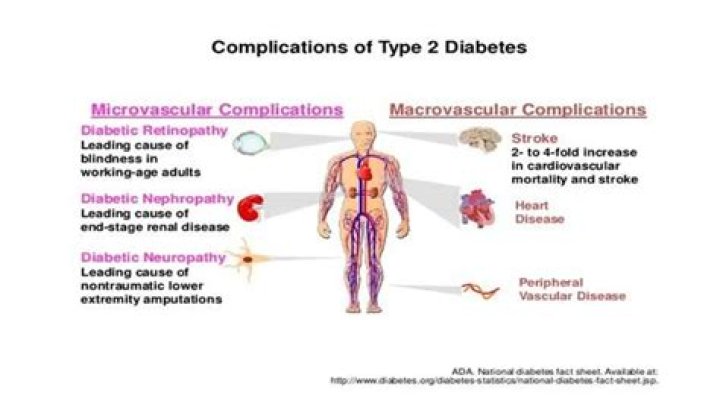 Case 73: Reversal of Type 2 Diabetes by Weight Loss Despite Presence of Macro- and Microvascular Complications - ePrints