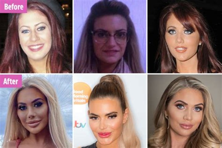 Cheek fillers before and after: How it changed the appearances of celebs from Megan Barton Hanson to Chloe Ferry