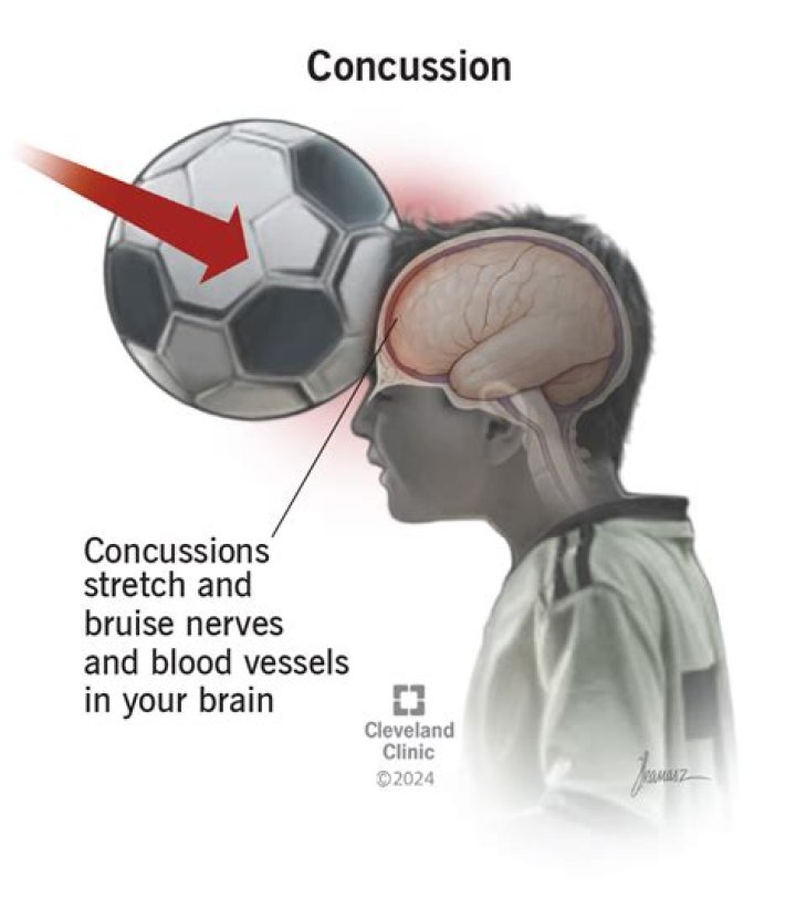 Concussions May Cause More Brain Damage in Kids With ADHD