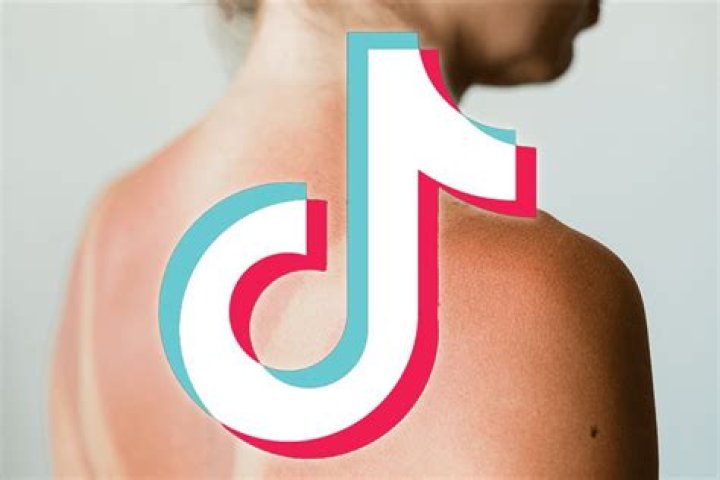 Dangerous sunburn tattoo trend goes viral as people ditch sun cream to create red shapes on their bodies – The Sun