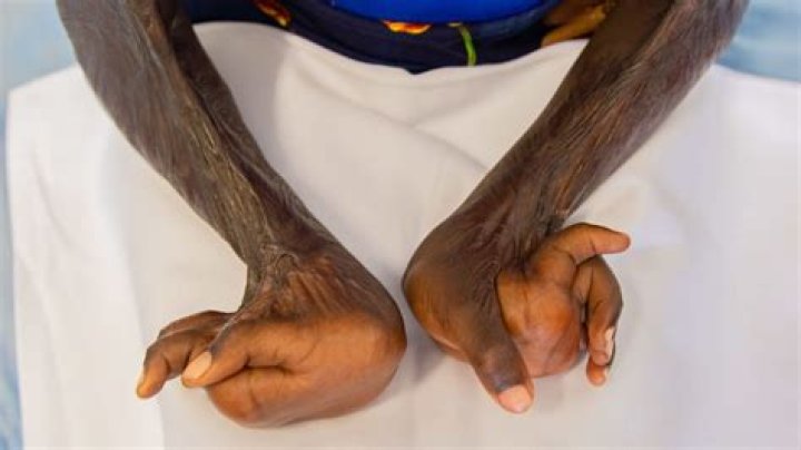Davenport man recovering after a fireworks accident severely injured his hand