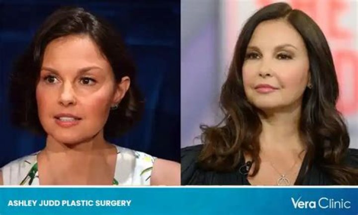 Decoding the Mystery Behind Ashley Judd’s Plastic Surgery