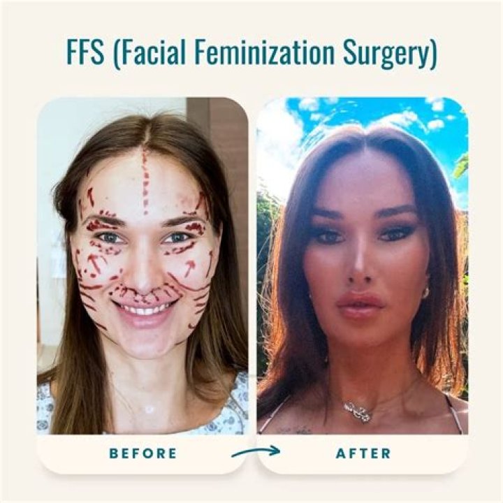 Dylan Mulvaney, a TikTok Influencer, Shows Her Facial Feminization Surgery Results