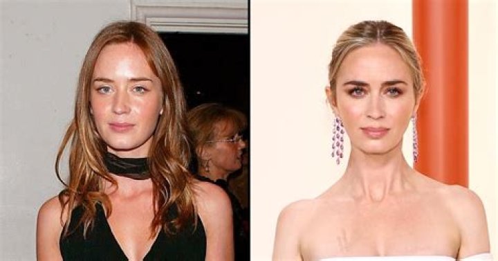 Emily Blunt Before and After: Did She Go for a Plastic Surgery?