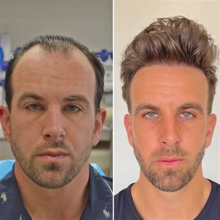 Fact Check: Did Tom Brady Get a Hair Transplant? Exploring Truth Behind QB’s Amazing Transformation From Baldness