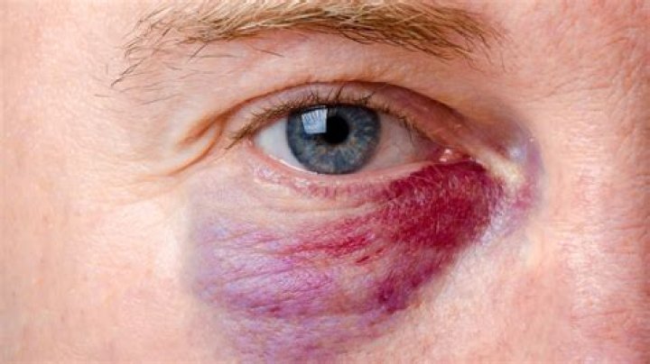 How Did Heather Gay Get A Black Eye? Theories, Memes & Tweets On The 'RHOSLC' Fight