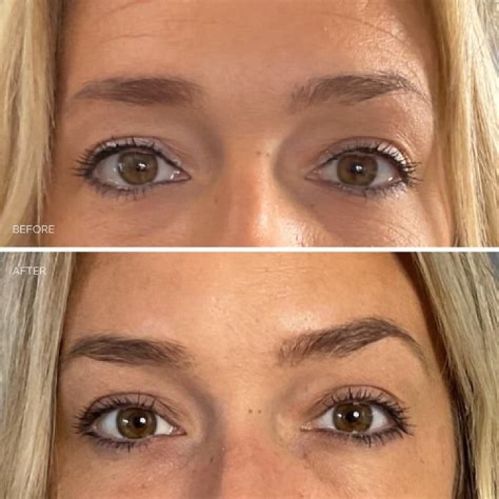 How did Lauren Hammersley’s eye end up? Has She Had a Browlift or Used Lenses?