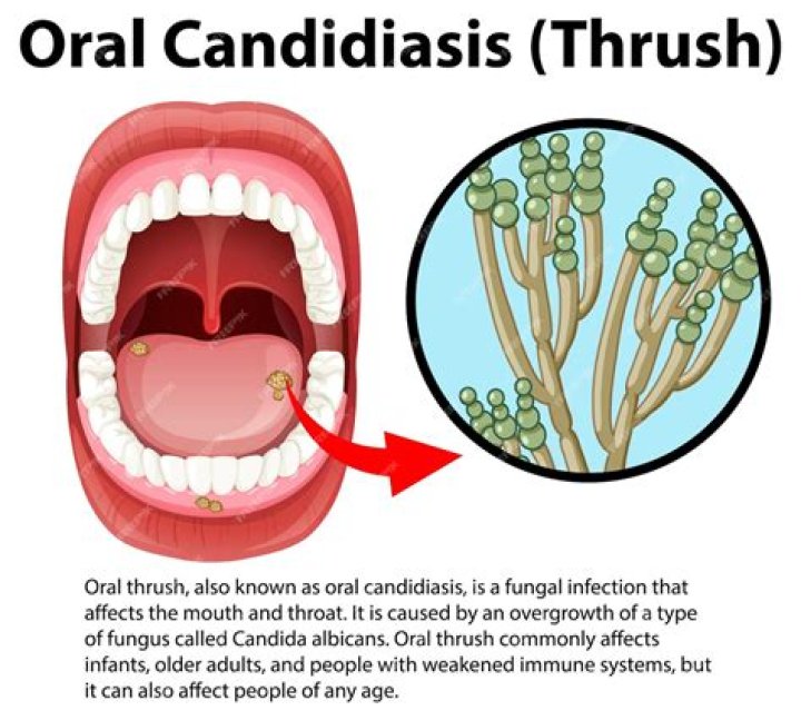 How to Recognize Thrush Symptoms (Oropharyngeal Candidiasis)