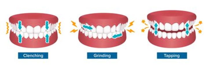 How to stop clenching or grinding your teeth