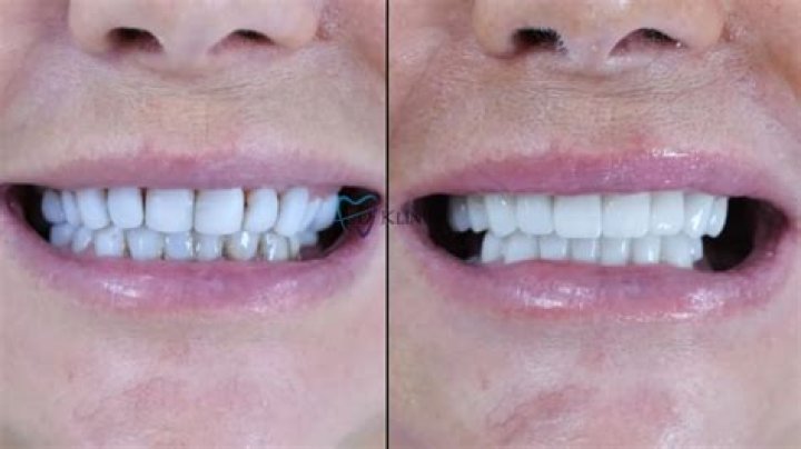I ordered clip-in veneers from Temu for my wedding but it was a total disaster - they look like horse teeth