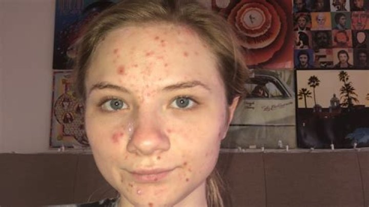 I was left with ‘permanent chickenpox’ for 10 years after picking my face for six hours a day