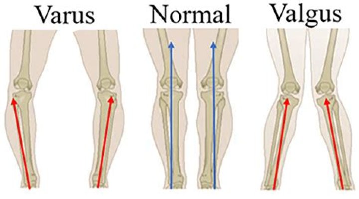 Is varus or valgus more common
