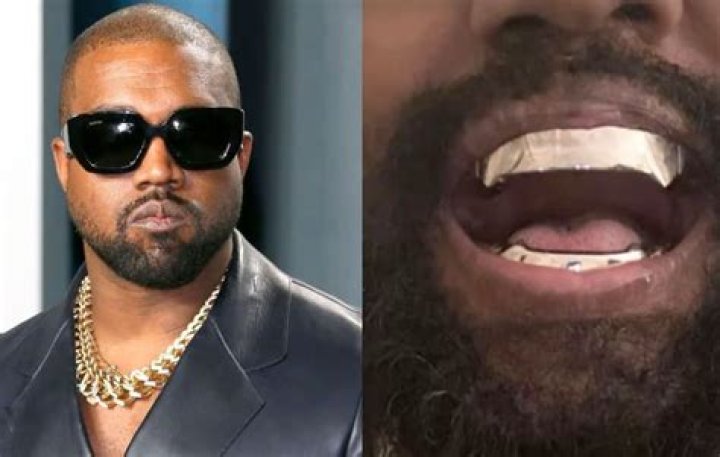 Kanye West Teeth Replaced with Expensive Titanium Dentures