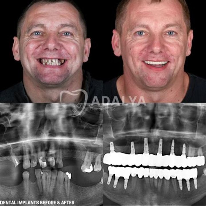 Lil Wayne Surgery: Jaw-Dropping Dental Transformation