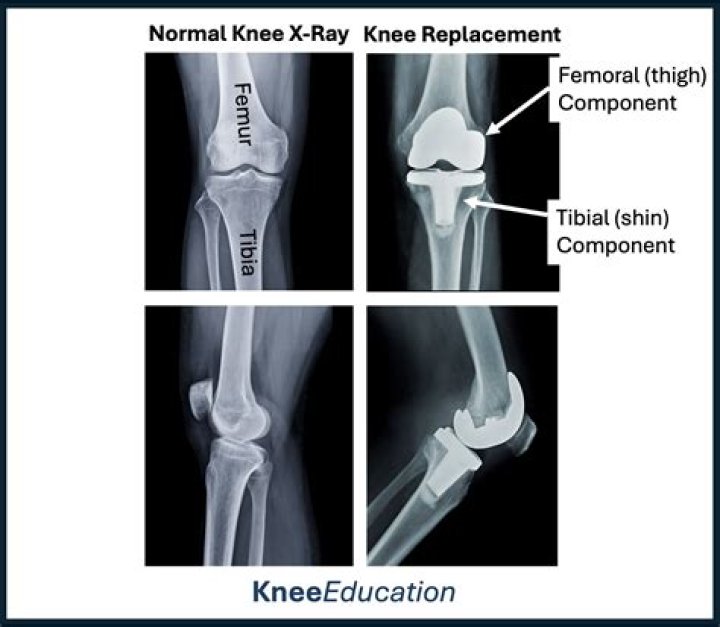 Manipulation of total knee replacements. Is the flexion gained retained? - ePrints