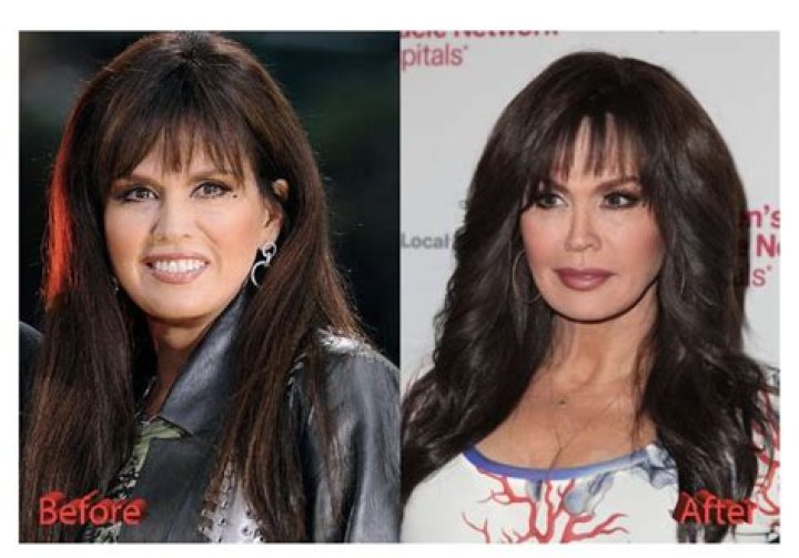 Marie Osmond Plastic Surgery: How She Maintains Her Youthful Looks