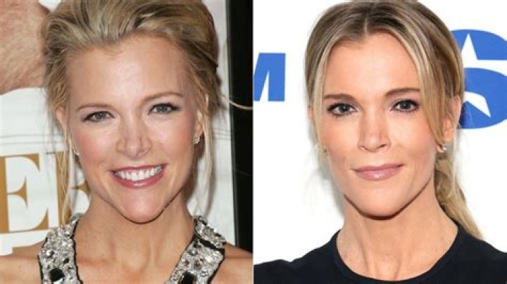 Megyn Kelly Plastic Surgery: Separating Fact from Fiction