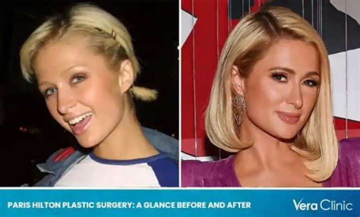 Paris Hilton’s Plastic Surgery: A Journey Through Time