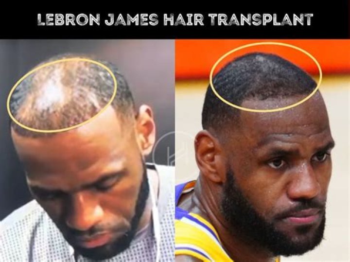Stop Making Fun Of LeBron James' Hair Loss