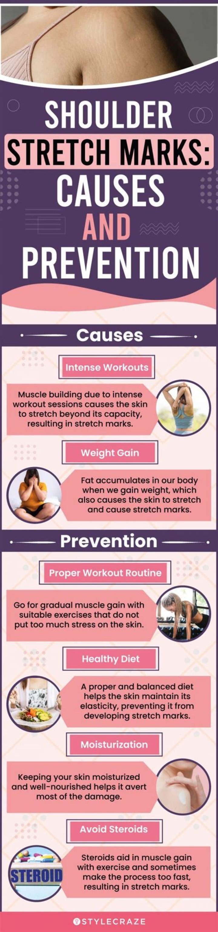 Stretch Marks on the Shoulders: Causes And Solutions Revealed