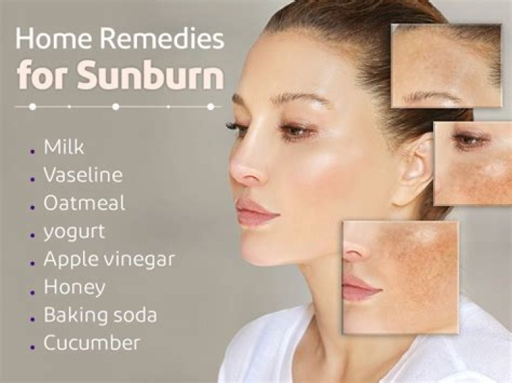 Sunburn: What helps and HURTS