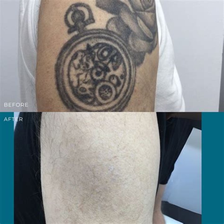 What Does Jordi Alba Tattoo Design Mean? Barcelona Star Hair Transplant Details