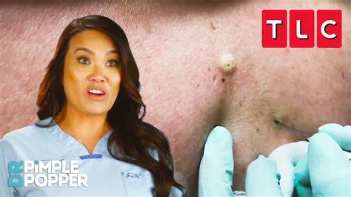 What Happened To Dr. Pimple Popper’s Patient Kevin Olaeta? Obituary California Update
