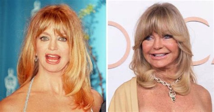 What Happened To Goldie Hawn’s Face? The Truth Behind Her Plastic Surgery Rumor