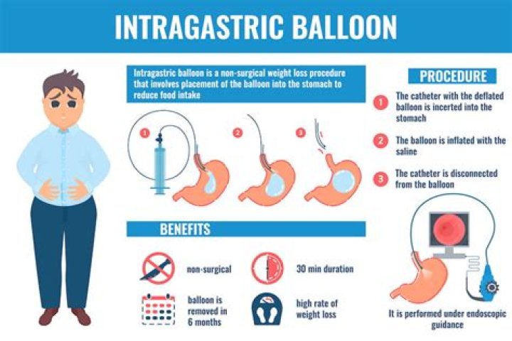 What is a gastric balloon and how can it help you lose weight? All you need to know