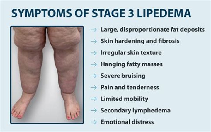Woman trolled after sharing inspiring weight loss journey... and discovering she suffers from rare condition lipoedema