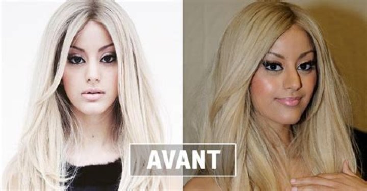 Zahia Dehar Avant Chirurgie : Son apparence avant les opérations esthétiques